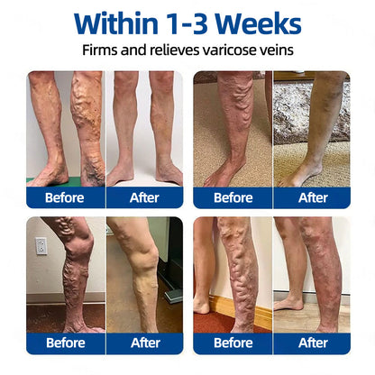 ✅𝐅𝐥𝐨𝐫𝐢𝐬𝐦𝐚® 𝐕𝐞𝐢𝐧𝐓𝐚𝐫𝐠𝐞𝐭 𝐌𝐢𝐜𝐫𝐨𝐧𝐞𝐞𝐝𝐥𝐞 𝐏𝐚𝐭𝐜𝐡⚡Instant Relief, Long-Term Results💚