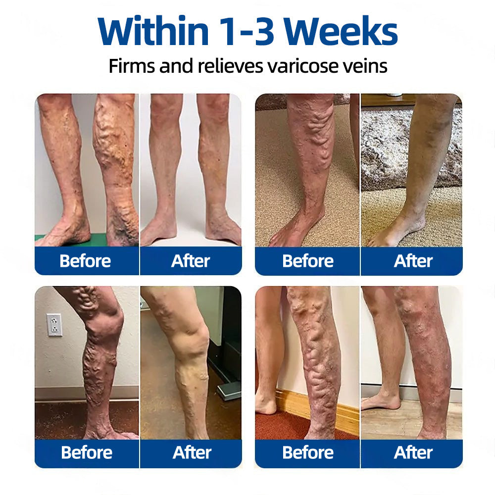 ✅𝐅𝐥𝐨𝐫𝐢𝐬𝐦𝐚® 𝐕𝐞𝐢𝐧𝐓𝐚𝐫𝐠𝐞𝐭 𝐌𝐢𝐜𝐫𝐨𝐧𝐞𝐞𝐝𝐥𝐞 𝐏𝐚𝐭𝐜𝐡⚡Instant Relief, Long-Term Results🏮