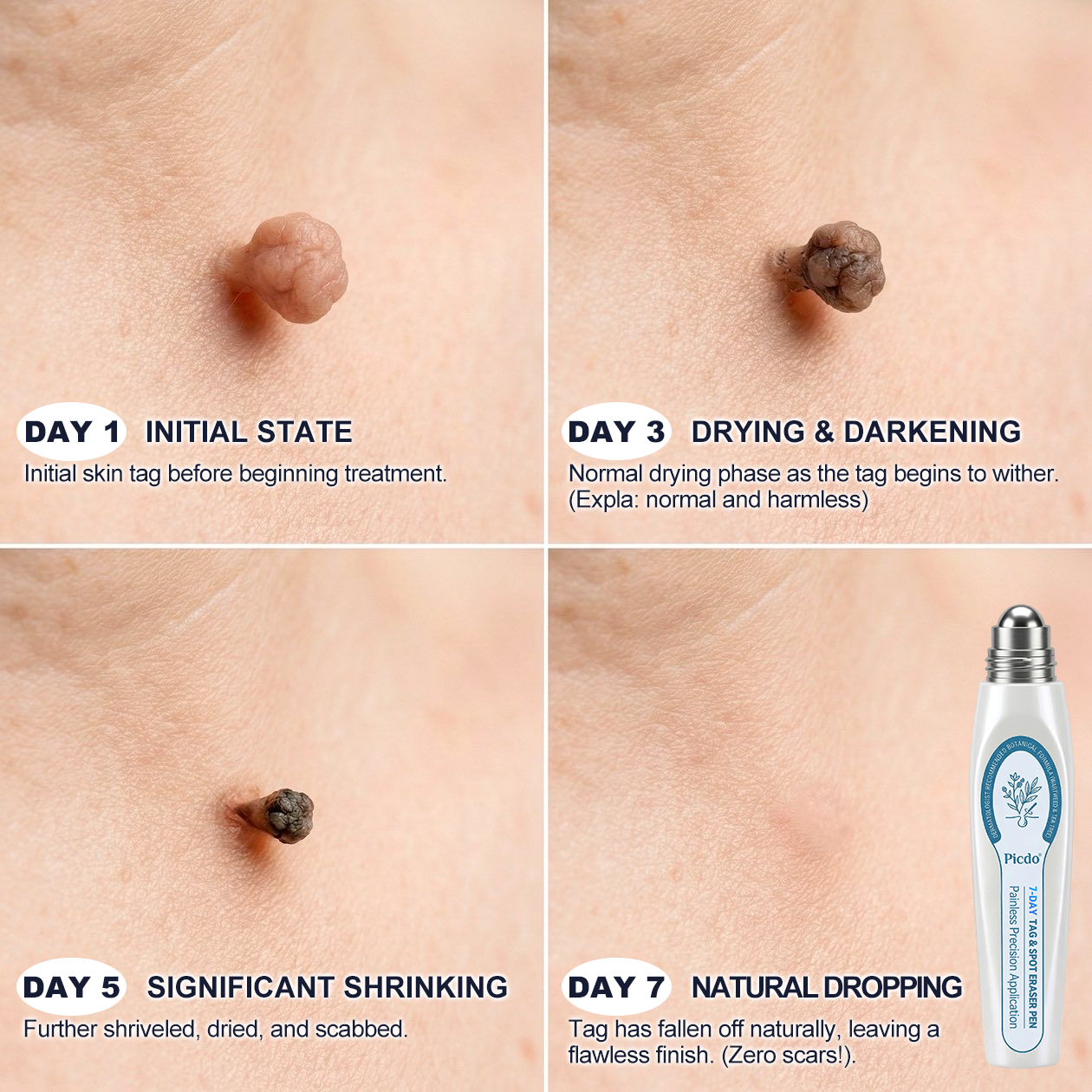 🗝️👑𝐏i𝐜𝐝o®7-𝐷𝑎𝑦 𝗧𝐚𝐠 & 𝗦𝗽𝐨𝐭 𝐄𝐫𝒂𝒔𝒆𝒓(Zero Pain, Zero 𝐒𝐜𝐚𝒓𝒔 Rollerball)