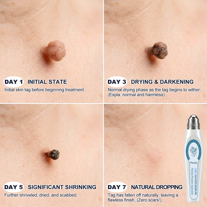 🗝️👑𝐏i𝐜𝐝o®7-𝐷𝑎𝑦 𝗧𝐚𝐠 & 𝗦𝗽𝐨𝐭 𝐄𝐫𝒂𝒔𝒆𝒓(Zero Pain, Zero 𝐒𝐜𝐚𝒓𝒔 Rollerball)